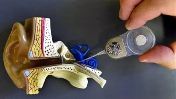 Orta kulakta sıvı birikmesinin tedavisi nedir?